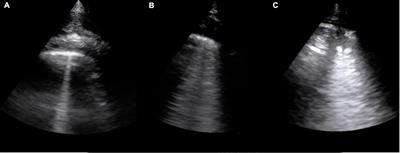Lung ultrasound in young children with neurological impairment: A proposed integrative clinical tool for deaeration-detection related to feeding